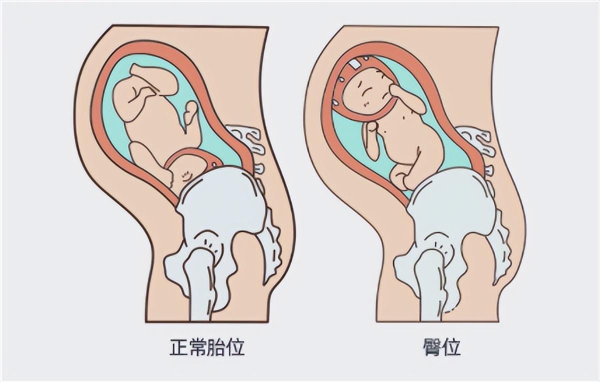 医生隔着妈妈肚皮将宝宝调了个头